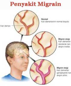 Cara mencegah migrain