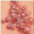 HERPES SIMPLEX