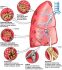 SAKIT BRONCHITIS