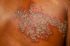HERPES ZOSTER