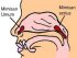 MIMISAN ATAU EPISTAXIS