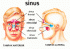 CARA TERAPI SAKIT SINUSITIS