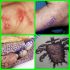 Penyakit Scabies